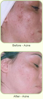 Before and after photos of acne treatment